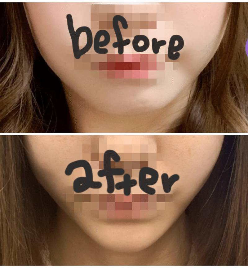 ヒアルロン酸とボトックス メロンちゃん Note