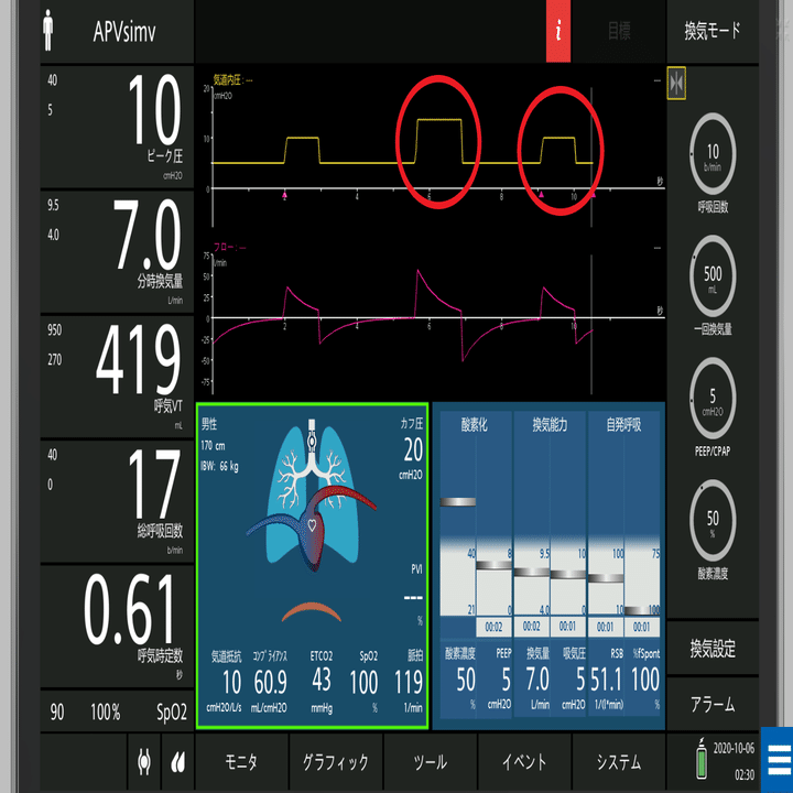 わかるまで解説する人工呼吸器②SIMVってなに？｜ムロ＠ケン