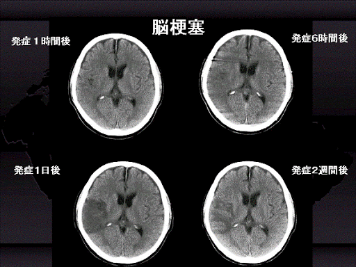 脳梗塞　脳MRI