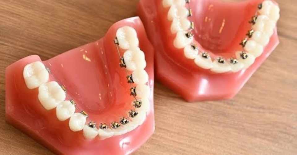 歯の矯正をしてても夜のお仕事はできるの 実際に裏側矯正をやってみた感想 みずしー Note