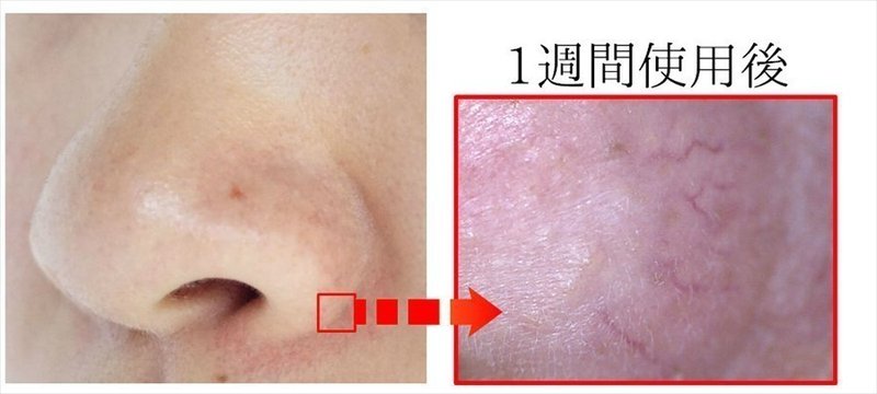 白漢しろ彩の使い方 3ヵ月で小鼻の赤みを消した使用法とは 美容ライターまめ Note