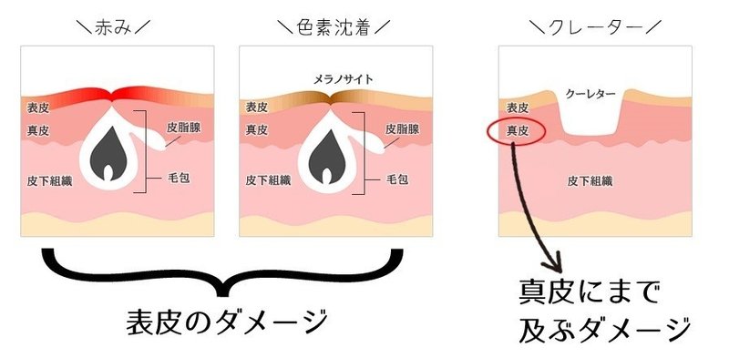 クレーターを作るな 顔がボコボコになる秘密 七年間ニキビで中学 高校の青春を失った僕がニキビを完全克服し 大学デビューを成功させ彼女を手に入れた ニキビ改善の神髄 Note クレーターを作るな 顔がボコボコになる秘密 七年間ニキビで中学 高校の青春を失った僕がニキビを完全克服し 大学デビューを成功させ彼女を手に入れた ニキビ改善の神髄 Note