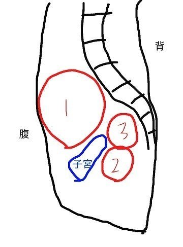 子宮筋腫で子宮全摘出しました 第４回 はつね Note
