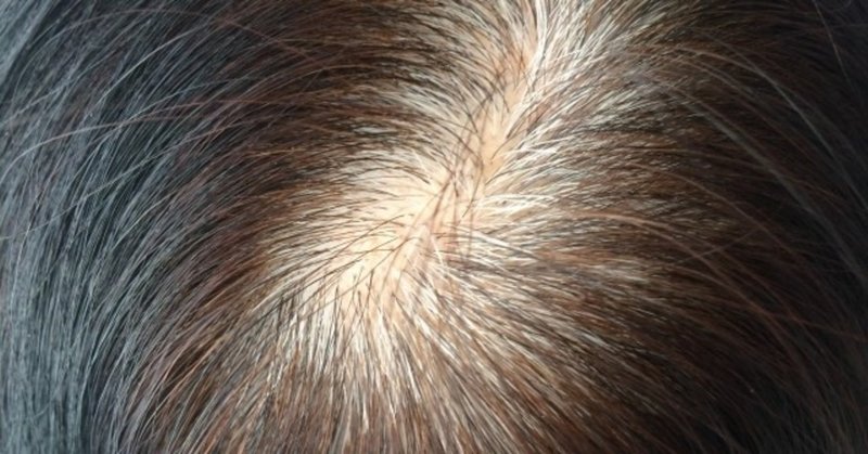 30代女性の薄毛対策に効果的な治療や対処法 Tackeyblog Note