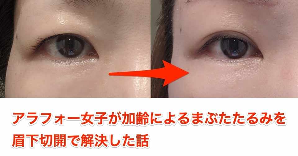 アラフォー女子が加齢によるまぶたたるみを眉下切開で解決した話 渋谷で働くアラフォー女子 Note