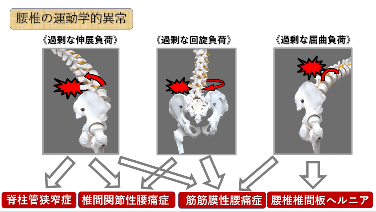 腰痛・下肢痛の診断と治療～骨盤と腰椎、股関節の関係を診る～全2枚(分売不可） 股関節は腰痛とも関連があります！】 | 慢性腰痛・坐骨神経痛