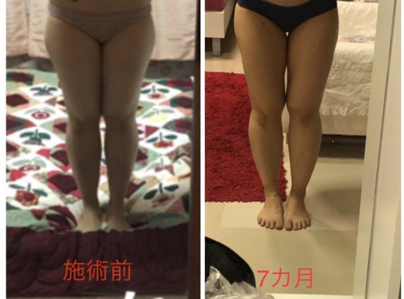 バンコクで脂肪吸引 太ももの脂肪吸引してきたのでレポ ビフォアフ写真あり パピカネー Note