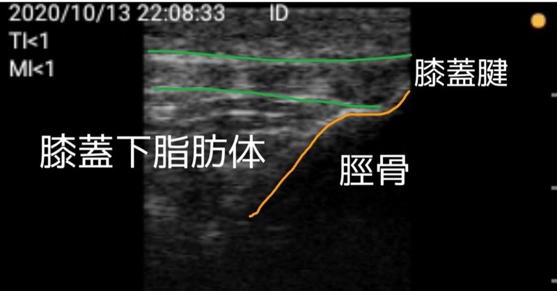 エコーで正常人の動きが解かるシリーズ 2 膝蓋下脂肪体 長軸画像 脛骨側 安静と等尺性収縮の反復 膝関節伸展0度 Ept Note エコーで正常人の動きが解かるシリーズ 2 膝蓋下脂肪体 長軸画像 脛骨側 安静と等尺性収縮の反復 膝関節伸展0度 Ept Note