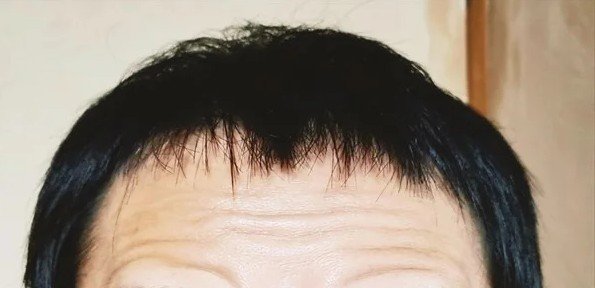 おでこのたるみ 目を見開くと おでこのシワ が気になる すべきケアとは 美容ライターまめ Note おでこのたるみ 目を見開くと おでこのシワ が気になる すべきケアとは 美容ライターまめ Note