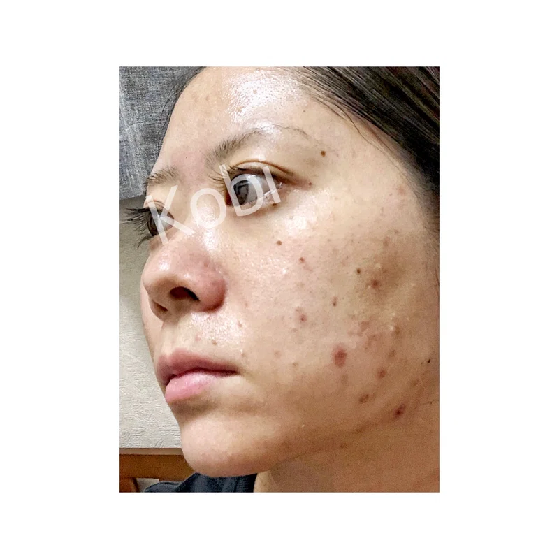 28歳にして肌が荒れた話 Kobi Note