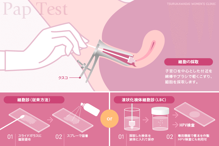 22歳で子宮頸がん健診で要精密検査になった 金色の眼鏡 25歳の実録いろいろ Note