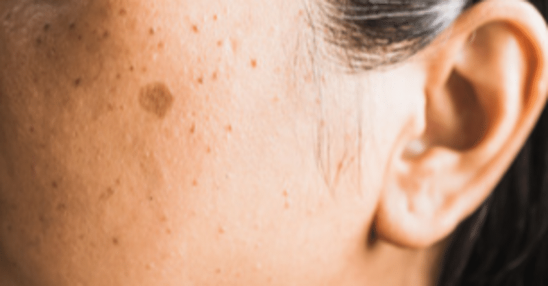 ダーマペンでシミが消える 美容外科の見解 セルフダーマペン効果検証ブログ Note