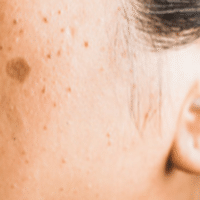 セルフダーマペンの失敗談 初心者に伝えたいこと セルフダーマペン効果検証ブログ Note