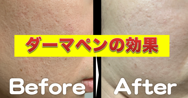 セルフダーマペン の新着タグ記事一覧 Note つくる つながる とどける