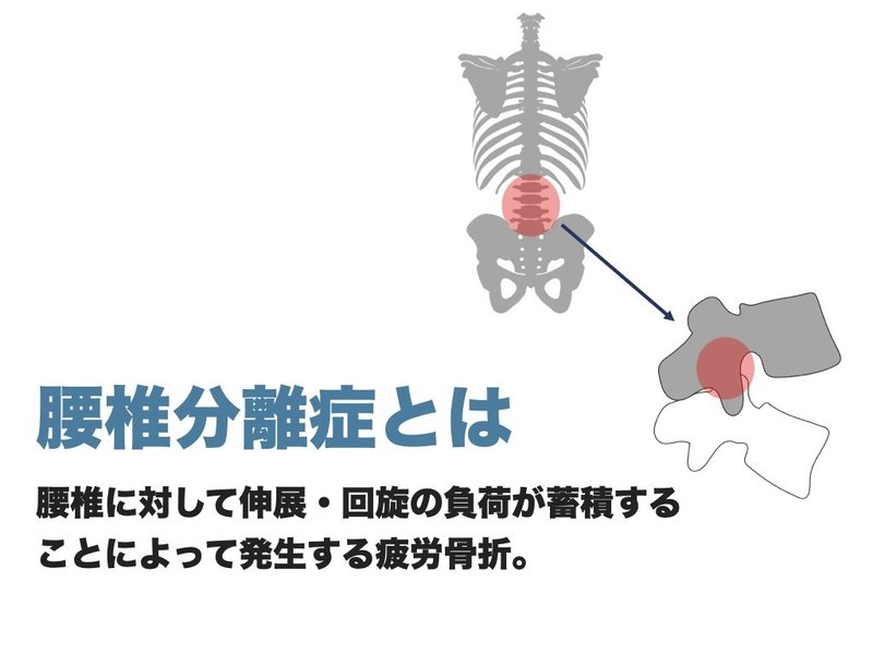 腰椎分離症の予防ストレッチ トレーニング L Fit Note