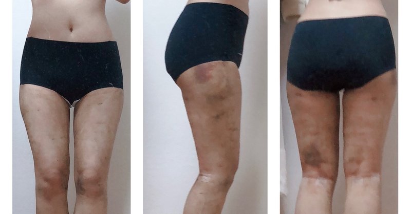 下半身脂肪吸引 Dt4日目 ちゃちゃちゃ Note