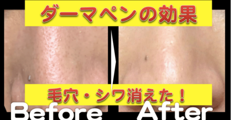 毛穴 シワが消えた セルフダーマペンの効果ブログ 口コミ セルフダーマペン効果検証ブログ Note