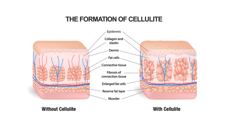 セルライトを解決する方法はあんまりない おおたしじみ Note