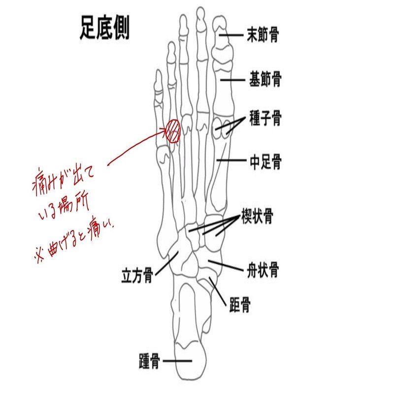 ランニングで足裏薬指の付け根に痛みが発症したらどうする 浦中 宏典 Hironori Uranaka Note