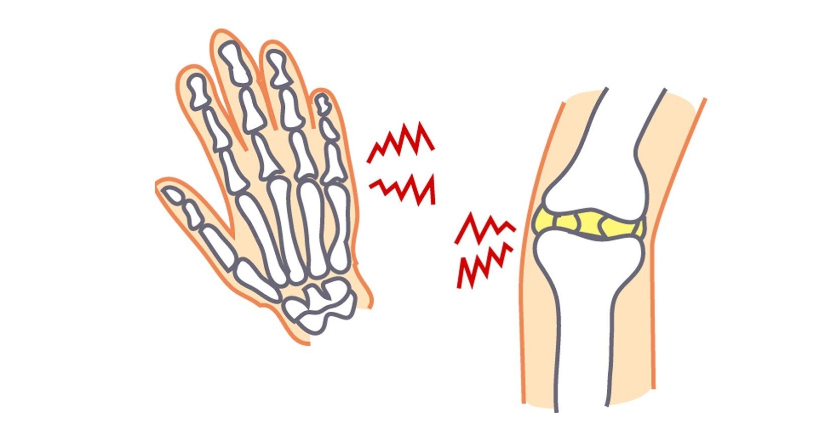 関節リウマチの痛み Yokoito イラスト Note 関節リウマチの痛み Yokoito イラスト Note