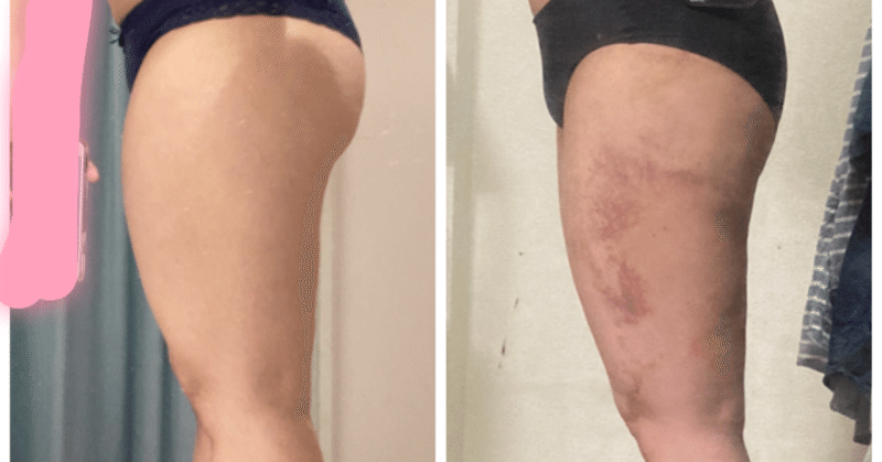 美容整形 足の脂肪吸引 経過報告 なまこ Note