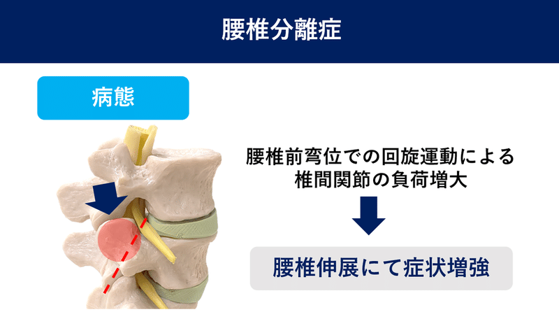 腰椎分離症 動作分析 佐藤 康 Note 腰椎分離症 動作分析 佐藤 康 Note