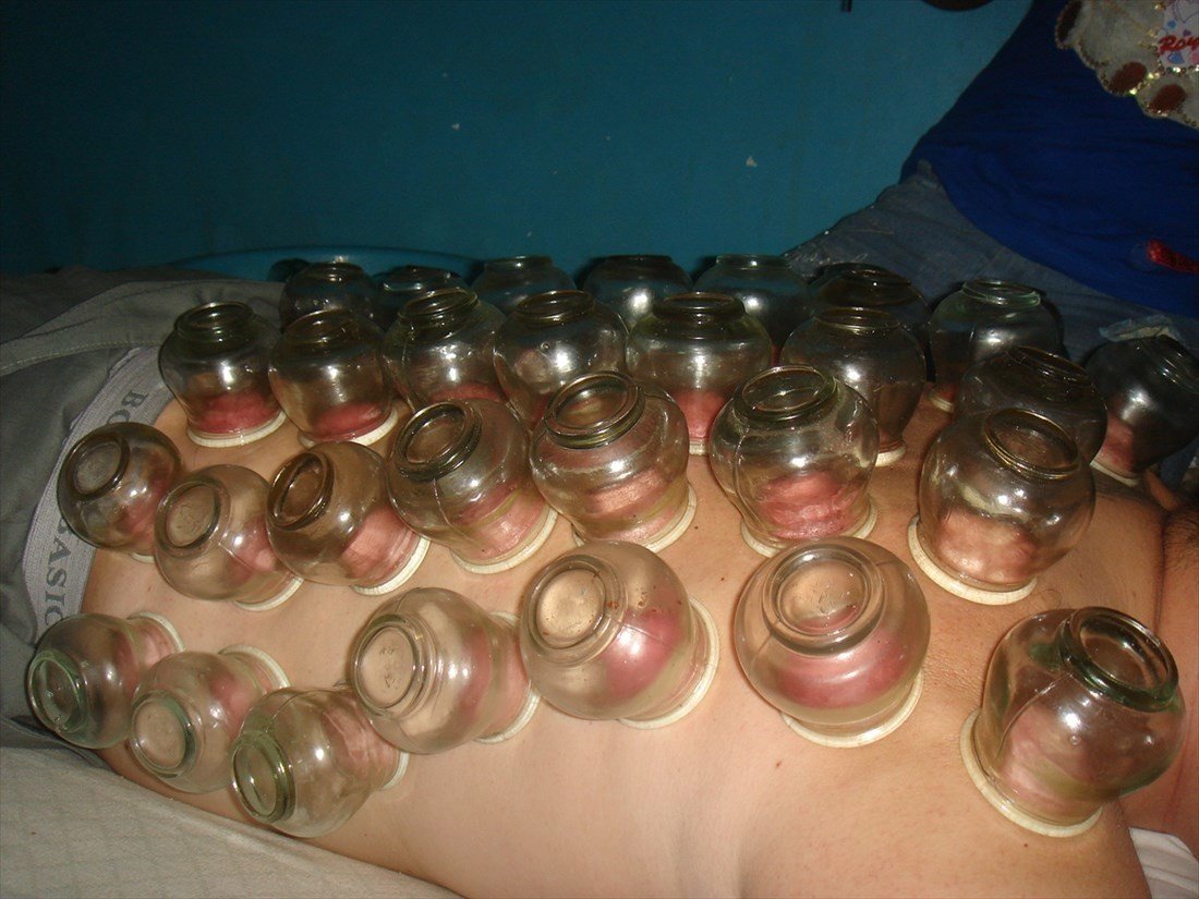 カンボジア伝統医学? 民間医療? 「チョップ・クチョル」｜在住歴20年が話したい本当のタイと見てきたこととうまい話と