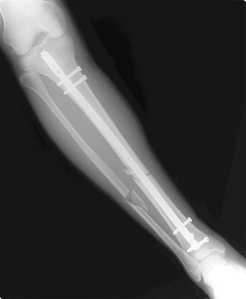 無料 Genの骨延長イリザロフ経験談 帰国後半年の投稿動画をもとに Gen 身長をカネで買った医者 Note