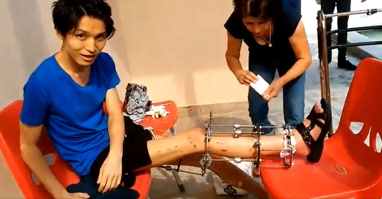 骨延長 の新着タグ記事一覧 Note つくる つながる とどける 骨延長 の新着タグ記事一覧 Note つくる つながる とどける