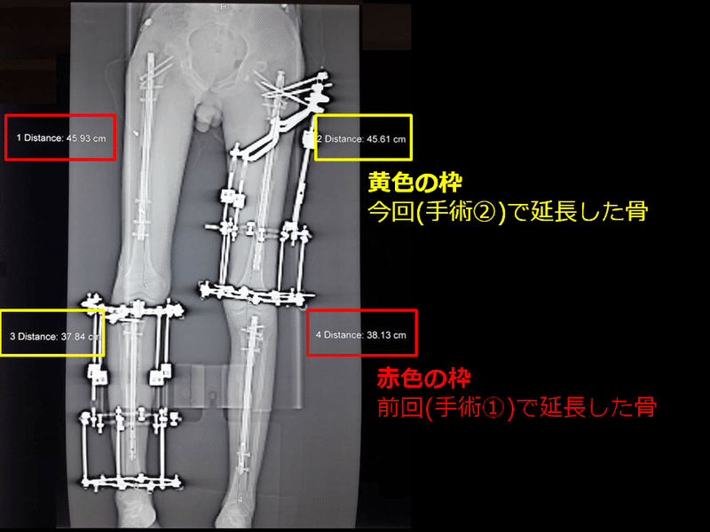 無料 ブログをもとに手術経過を振り返る 俺の骨延長イリザロフ手術 Gen 身長をカネで買った医者 Note 無料 ブログをもとに手術経過を振り返る 俺の骨延長イリザロフ手術 Gen 身長をカネで買った医者 Note