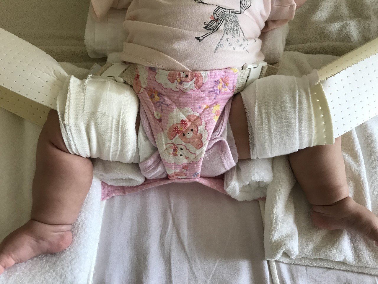 股関節脱臼の治療ー牽引方法ー ファミリハつくば Note 股関節脱臼の治療ー牽引方法ー ファミリハつくば Note