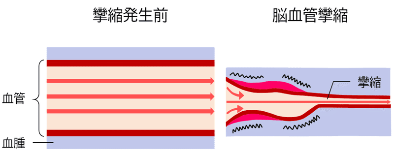 血管攣縮