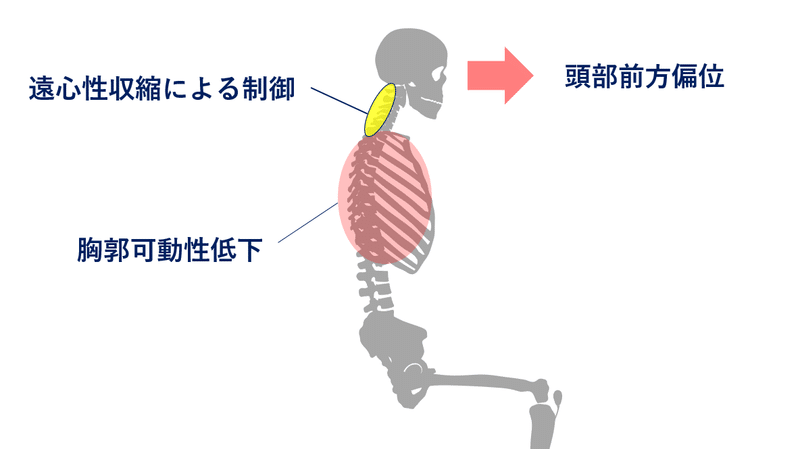 頭部前方偏位