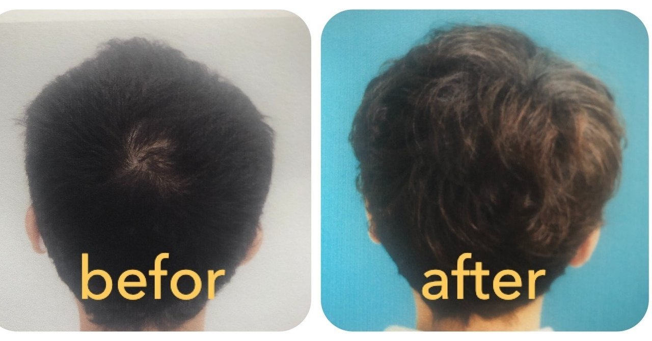 え まだクリニックにいってるの クリニックに行かずとも髪を生やす方法 Takesi Note