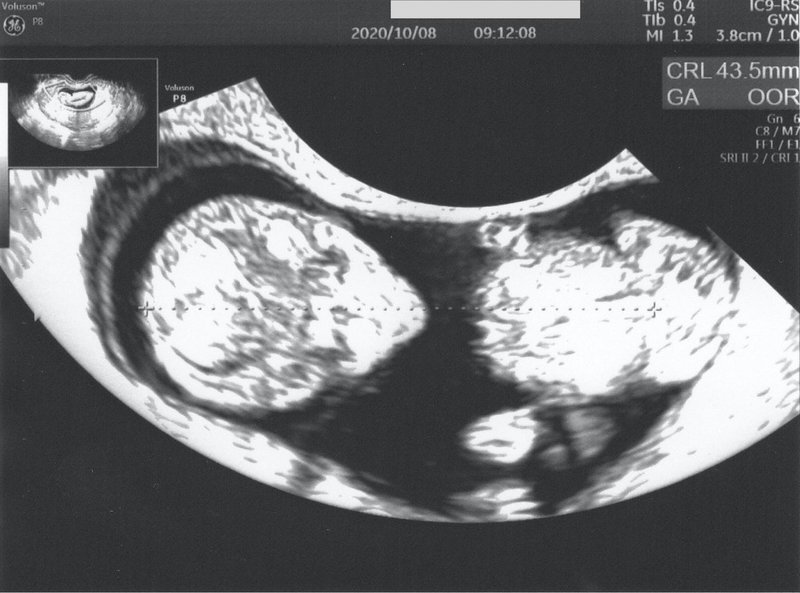 エンジェルサウンズに心を救われる 妊娠9w 11w日記 Akatsuki174 Note