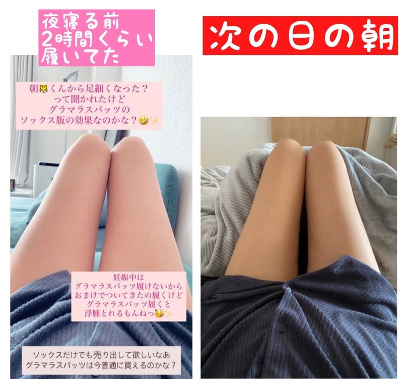 寝る時に着圧ソックス履くのやめました みみねこ Note 寝る時に着圧ソックス履くのやめました みみねこ Note