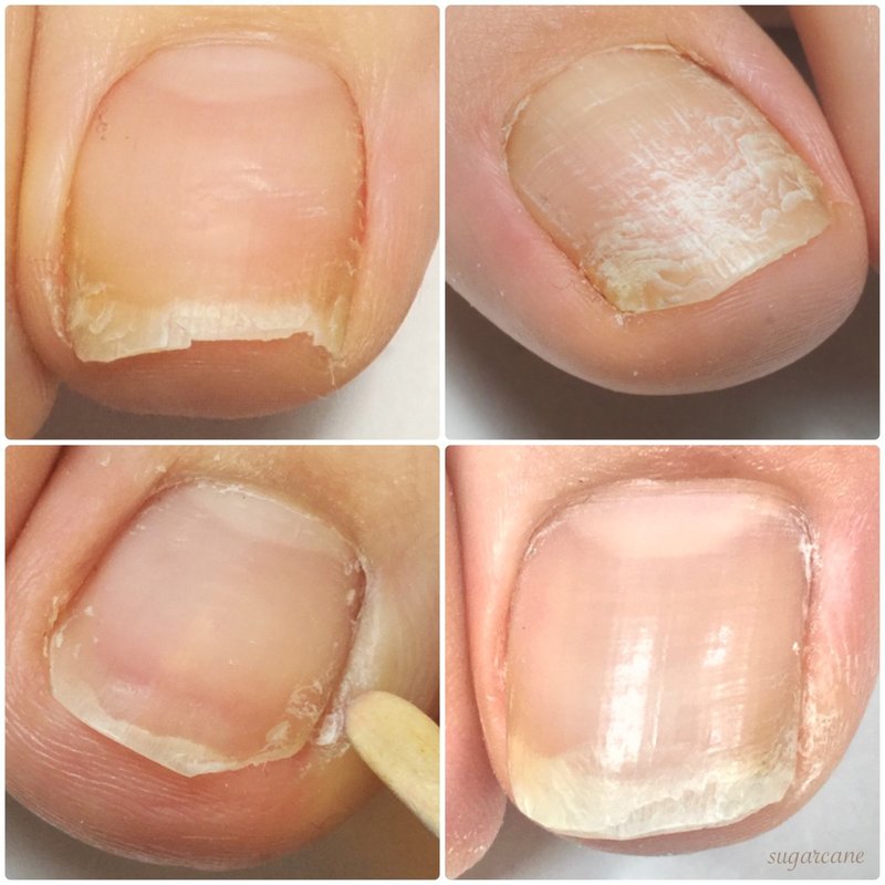 2枚爪になり易い爪 なり難い爪 Nailsalon Sugarcane Note 2枚爪になり易い爪 なり難い爪 Nailsalon Sugarcane Note