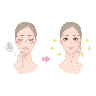 ダーマペン１回後の効果です たった1回でも 鼻の毛穴はだいぶ消えました 多くの詳細画像は こちらの記事に載せました Note Com Self Dermapen N N165e4 セルフダーマペン効果検証ブログ Note