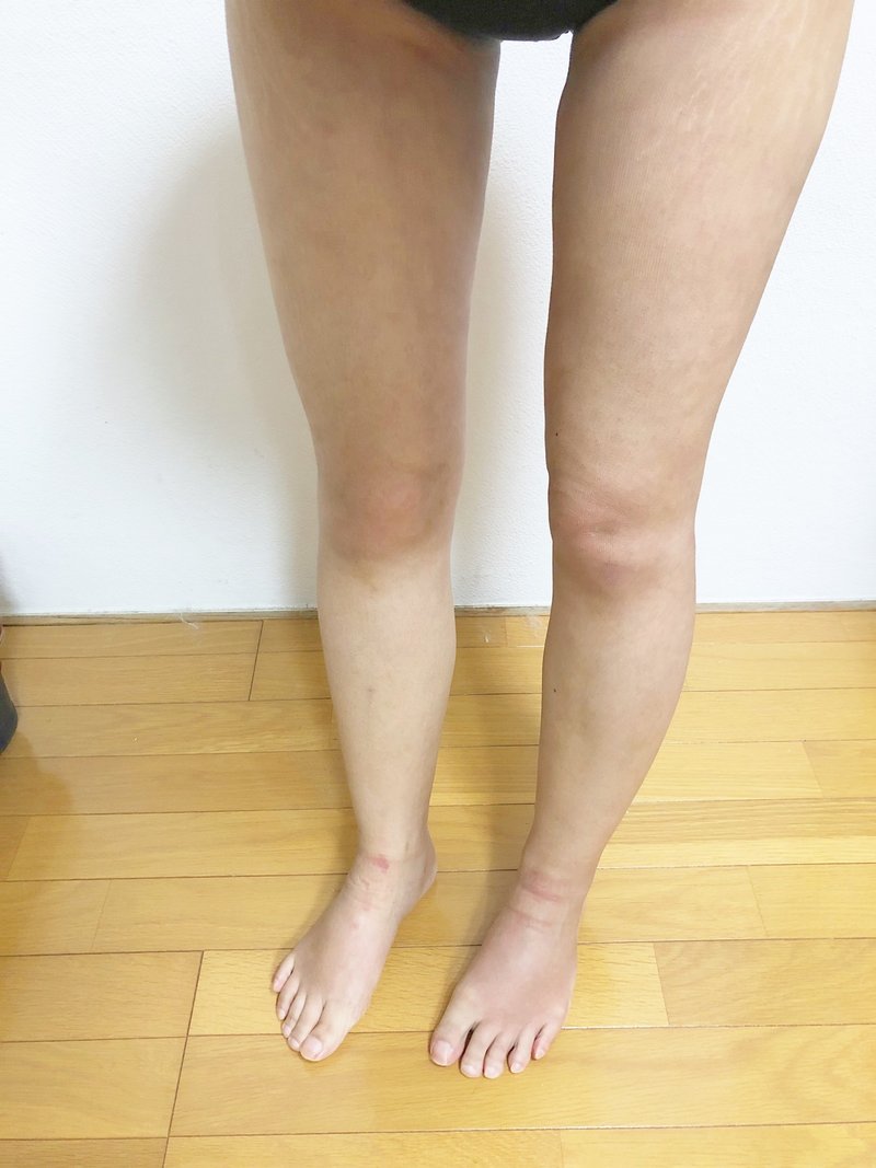 下半身脂肪吸引 Dt22 24日目 ちゃちゃちゃ Note 下半身脂肪吸引 Dt22 24日目 ちゃちゃちゃ Note