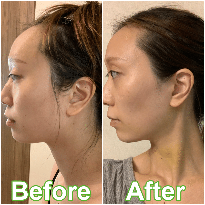 コロナ太りで脂肪吸引を決意 美容医療 整形の口コミ予約アプリ トリビュー Note