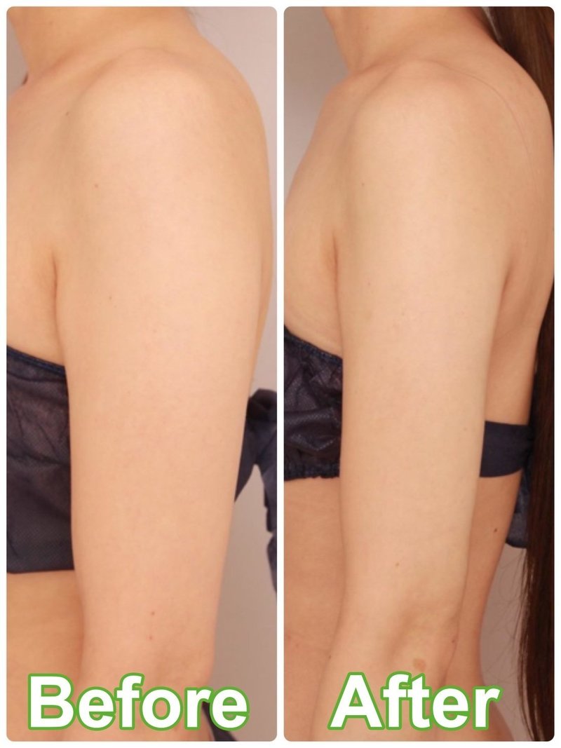 コロナ太りで脂肪吸引を決意 美容医療 整形の口コミ予約アプリ トリビュー Note