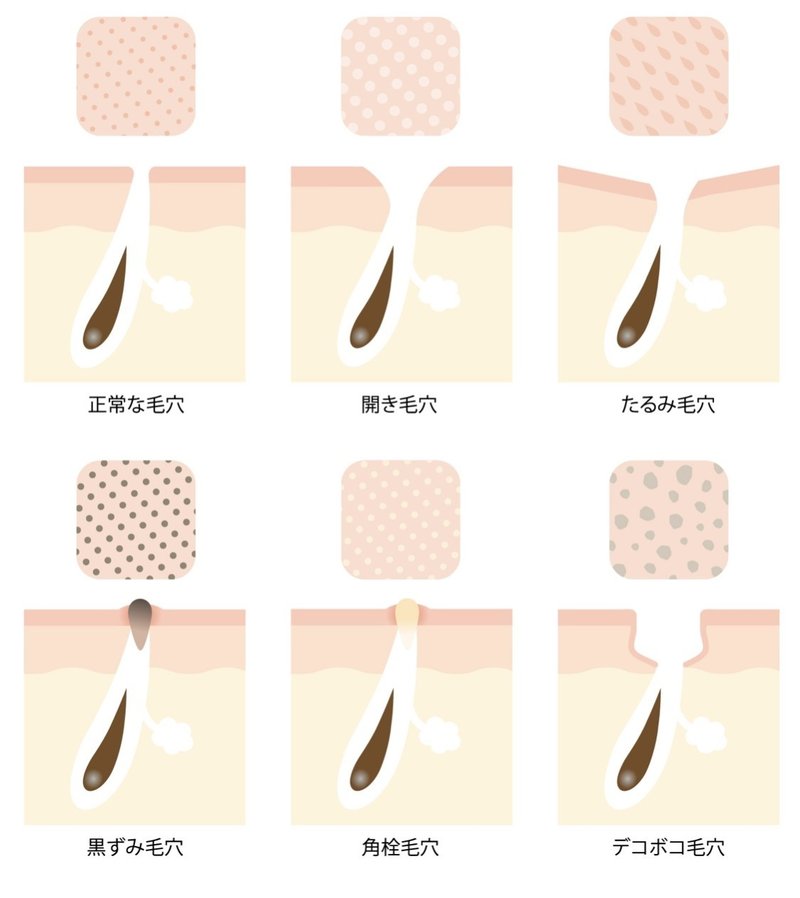 進行すると老け顔に ただの毛穴目立ちじゃない たるみ毛穴 とは はだみ Note