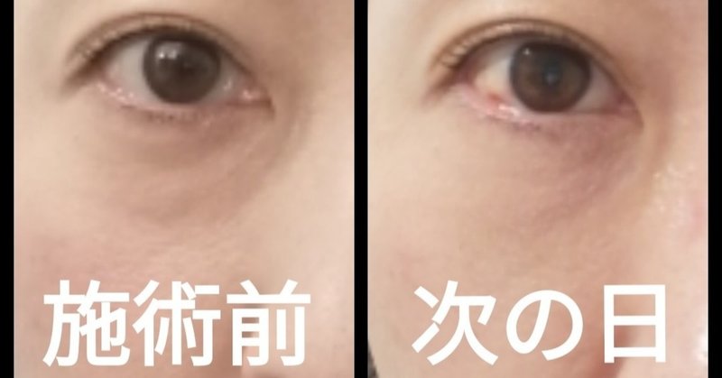 眼窩脂肪 の新着タグ記事一覧 Note つくる つながる とどける