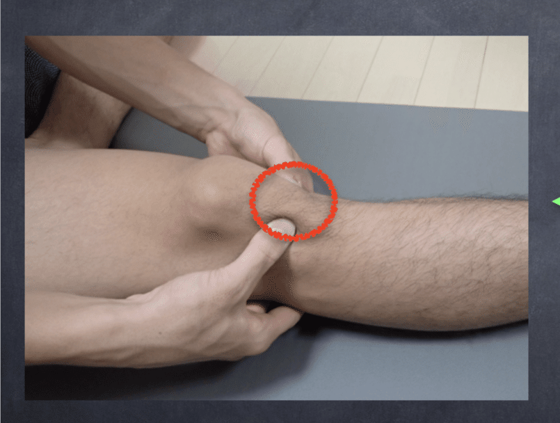 膝蓋下脂肪体 たか理学療法士 リハビリ Note