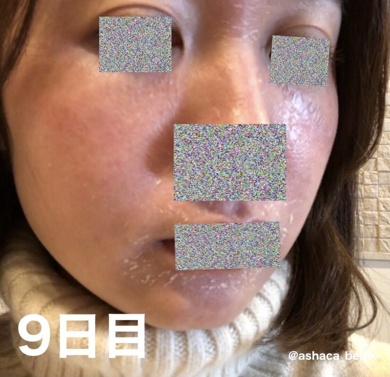 人生を変えるスキンケア ゼオスキン セラピューティック1ヶ月目レポート あしゃ Note 人生を変えるスキンケア ゼオスキン セラピューティック1ヶ月目レポート あしゃ Note
