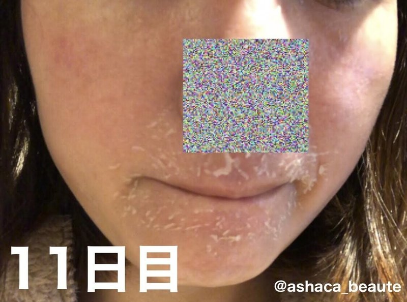 人生を変えるスキンケア ゼオスキン セラピューティック1ヶ月目レポート あしゃ Note