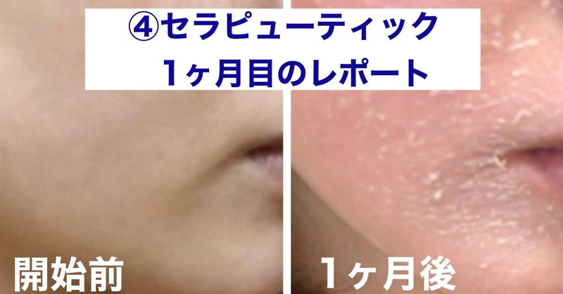 人生を変えるスキンケア ゼオスキン セラピューティック1ヶ月目レポート あしゃ Note