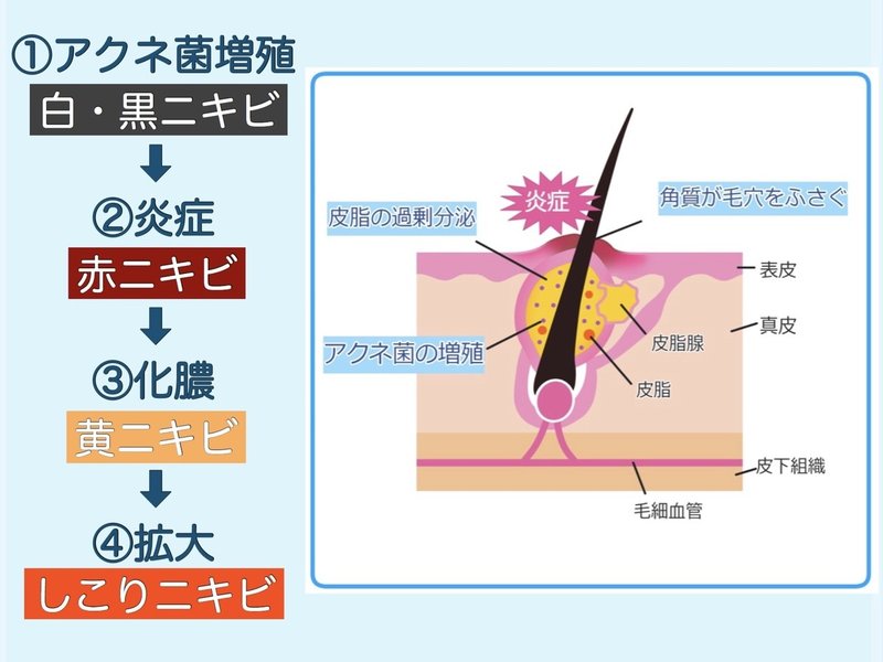 で 日 ニキビ オロナイン 一 治す