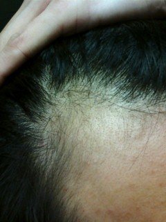 ハゲ家系の男が実践して生え際が前進した記録その2の話 おれの生え際さらし画像つき 色恋錬金術師 いちえもん Note ハゲ家系の男が実践して生え際が前進した記録その2の話 おれの生え際さらし画像つき 色恋錬金術師 いちえもん Note
