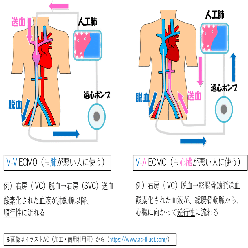 100円記事】ECMOの造影CTを撮ろうよ～前編～｜ペサ山🥨診療放射線技師